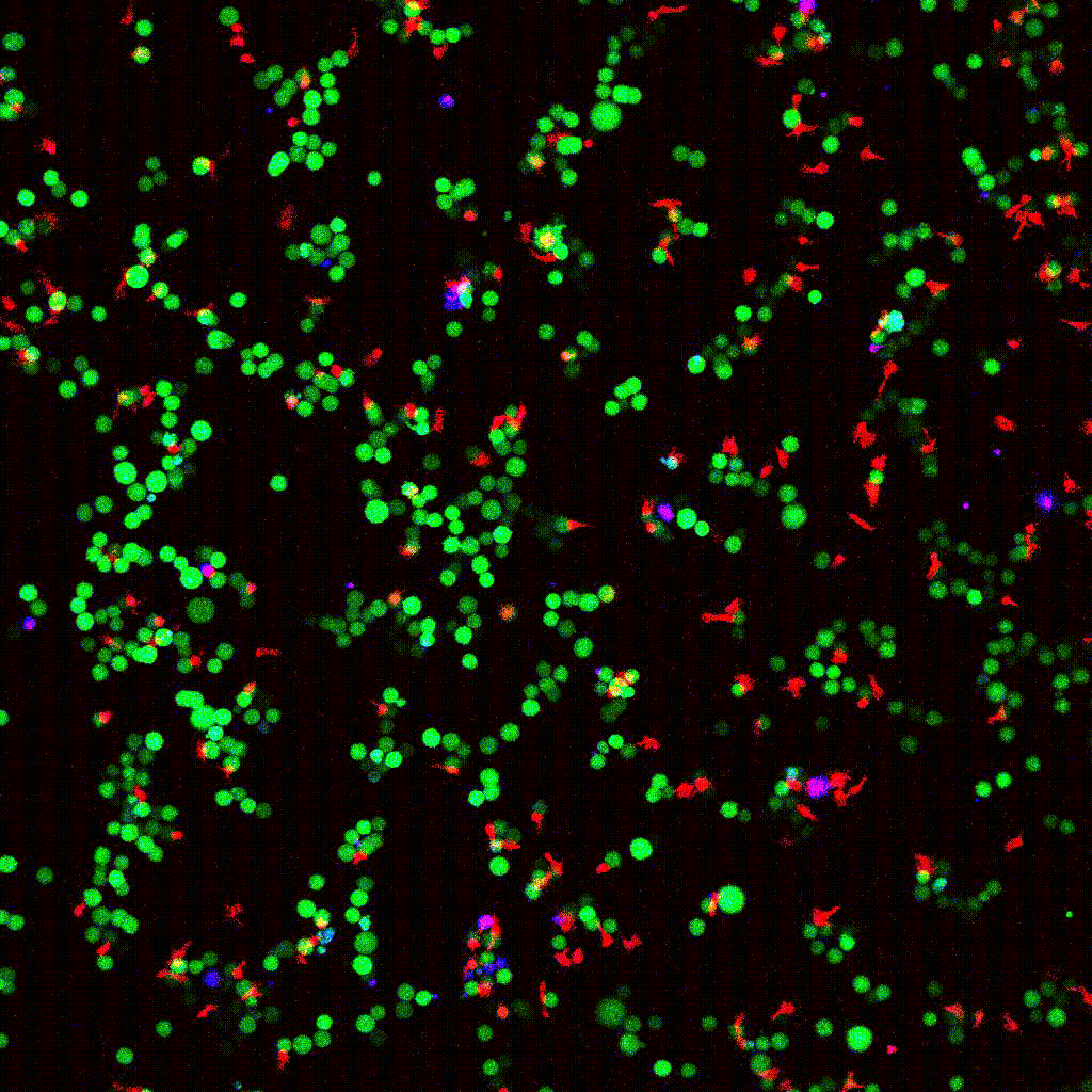 Confocal cytotoxicity assay: eGFP NY-ESO-1 tumor cells (green) targeted by engineered T cells (red); PI death marker (blue)